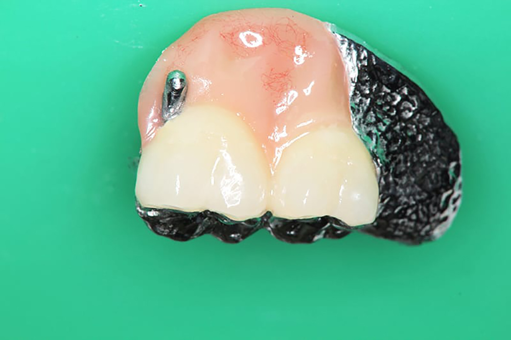 定期的な歯のクリーニング(メインテナンス)