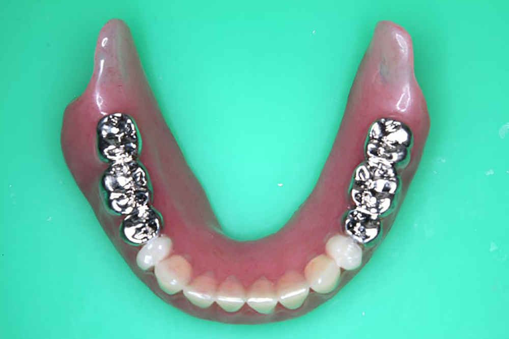 金属歯