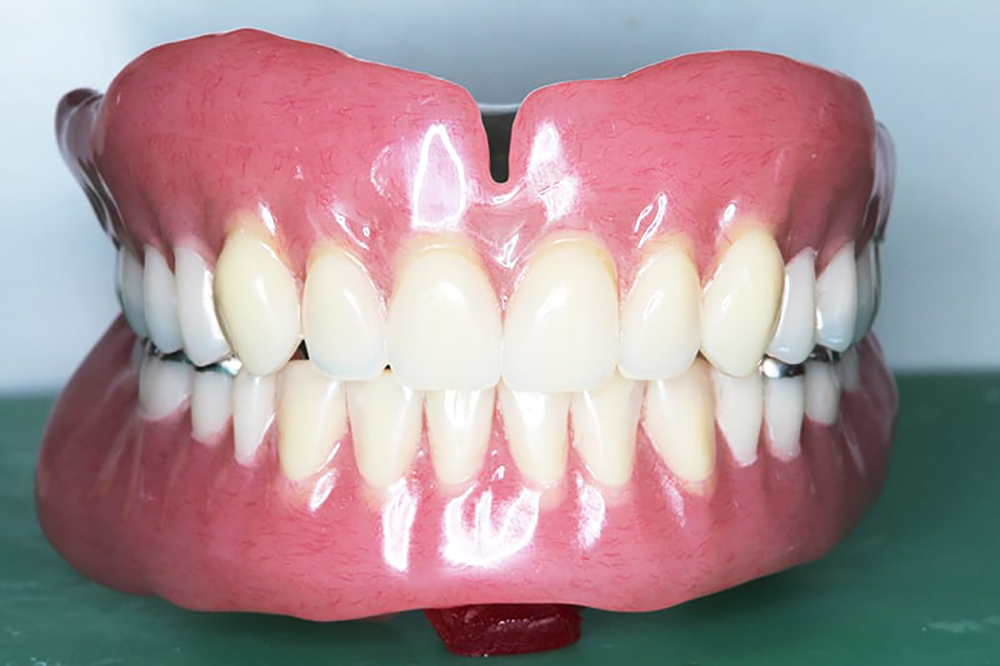 治療用入れ歯　治療義歯